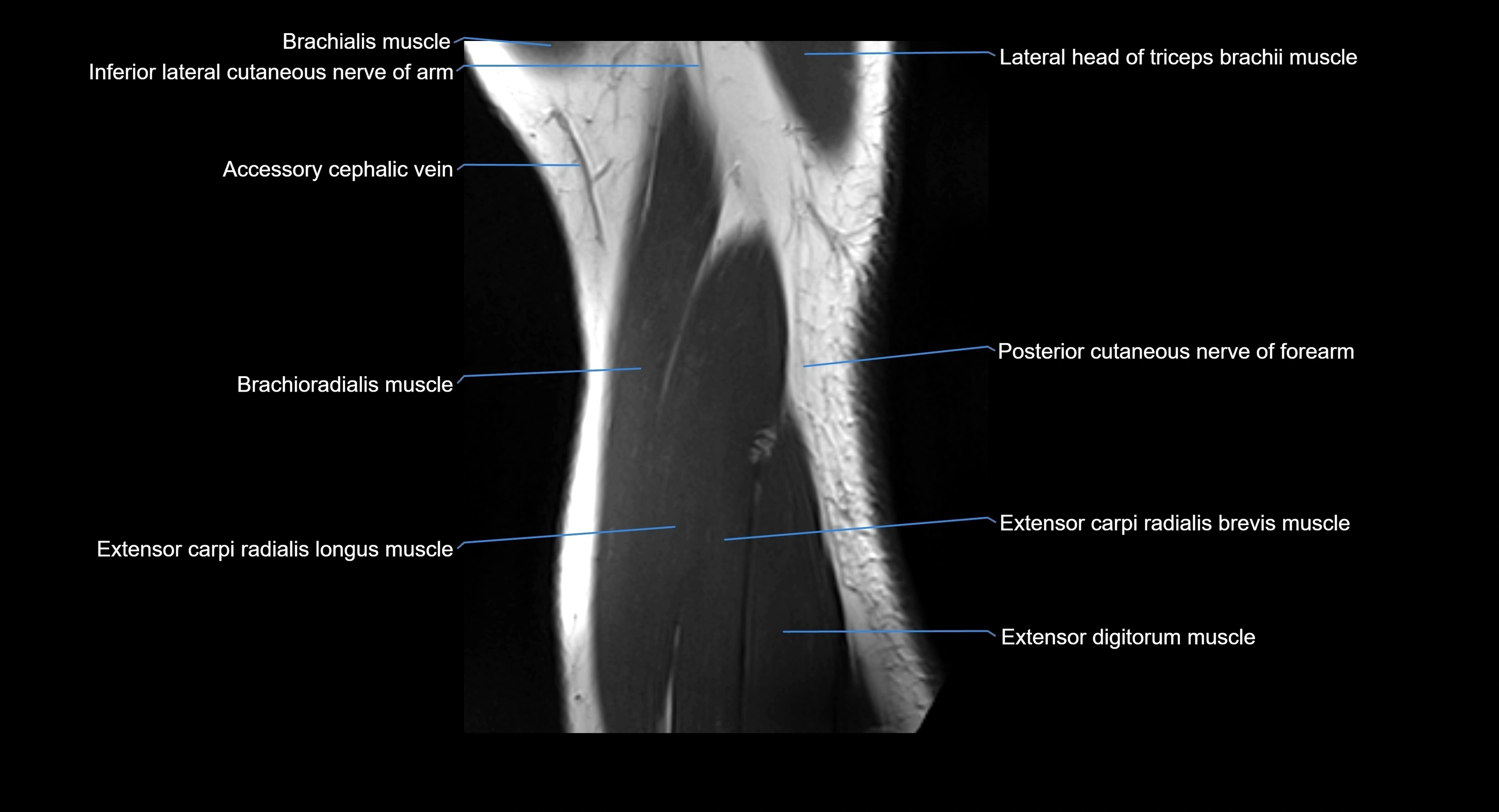 MRI elbow joint  sagittal cross sectional anatomy 3T  radiology  image-img-00001-00023.webp